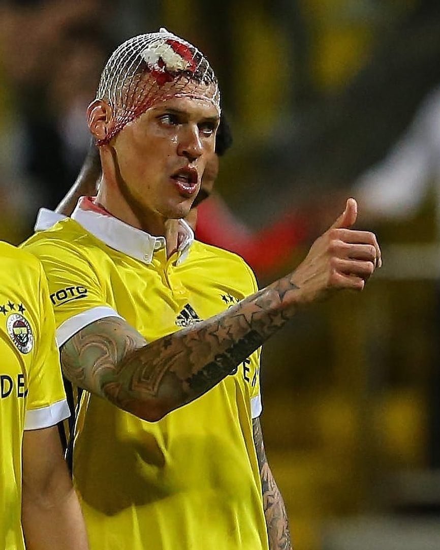 AnythingLFC_'s tweet image. Martin Skrtel’s head split open from a head to head collision yesterday - he stayed on the pitch

He got five stitches at half time &amp;amp; didn’t want to be subbed off

After the game he went to the hospital to receive 5 more stitches

What a guy!