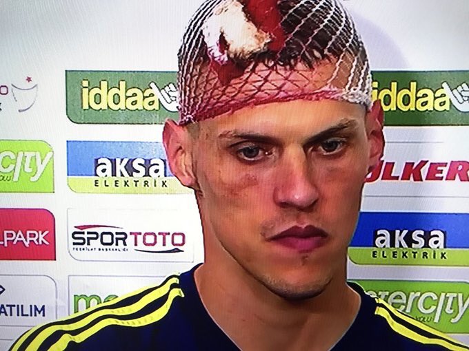 AnythingLFC_'s tweet image. Martin Skrtel’s head split open from a head to head collision yesterday - he stayed on the pitch

He got five stitches at half time &amp;amp; didn’t want to be subbed off

After the game he went to the hospital to receive 5 more stitches

What a guy!