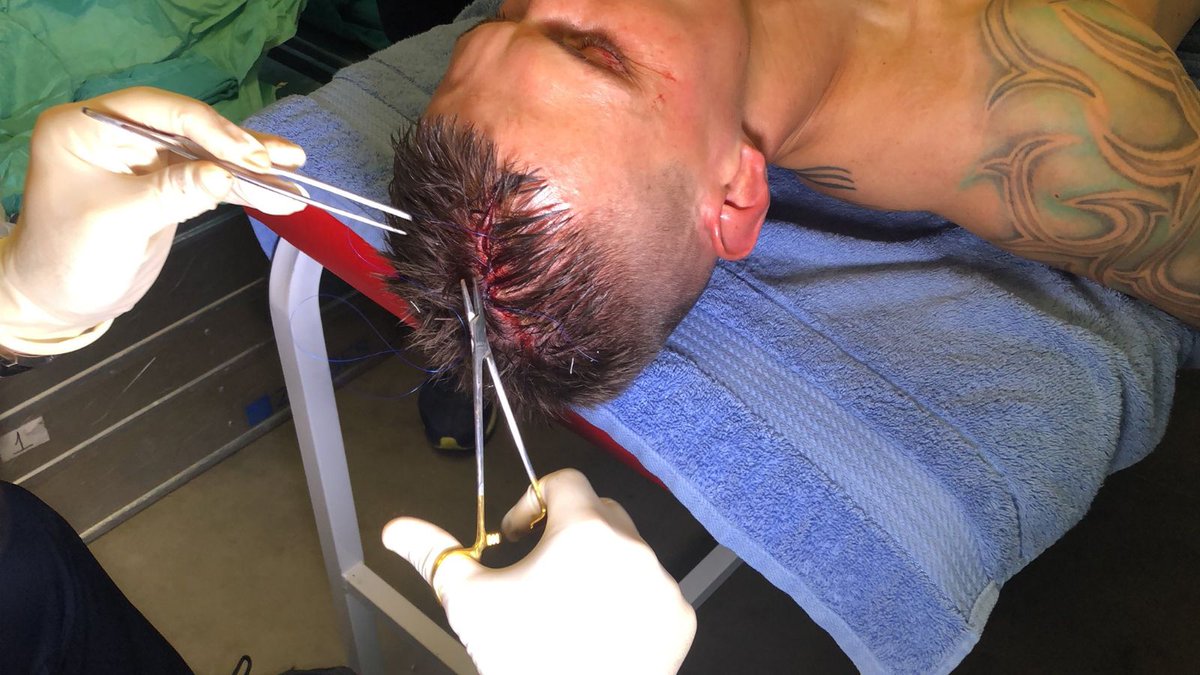 AnythingLFC_'s tweet image. Martin Skrtel’s head split open from a head to head collision yesterday - he stayed on the pitch

He got five stitches at half time &amp;amp; didn’t want to be subbed off

After the game he went to the hospital to receive 5 more stitches

What a guy!