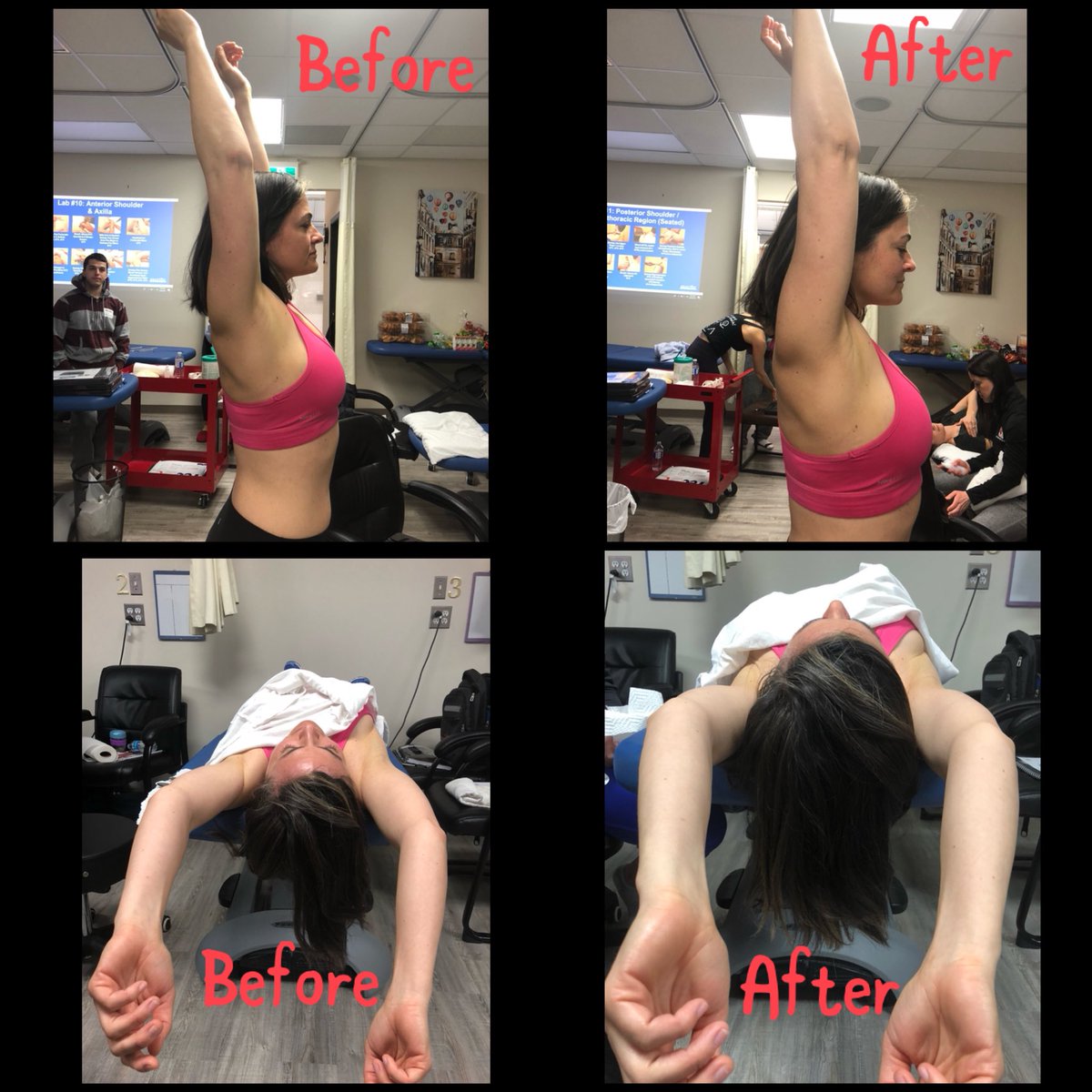 DrReenaPathak's tweet photo. Graston Technique Therapy to the rotator cuff was done and this picture is showing an increase in shoulder flexion. #results #wincitychiro #drreena #grastontechnique #handsonhealth @GT_Treatment https://t.co/TD7Cl48dtO