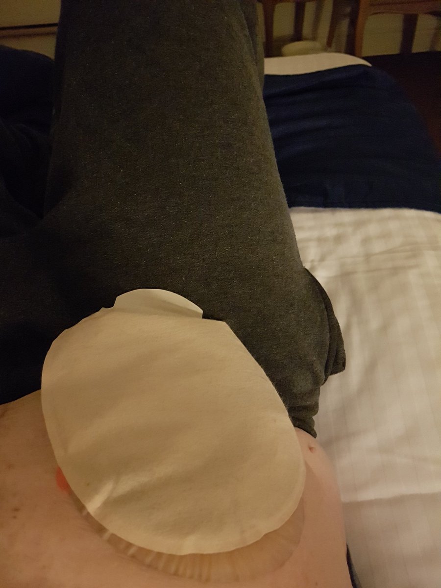 devon_ia's tweet photo. On hols in Newquay hopefully it will be warmer and drier tomorrow 😁 #stoma #stomaawareness #ileostomy #colostomy #stomalife #stomaissues https://t.co/JUySTUGcfi