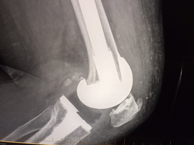 ElaZemp2's tweet photo. @neiltheknee @mattbarbermd @mykneeguide @alortho @Dr_Stambough @DrLeeRubin @MobileSportsDoc @KneeReplacement @D1SportsMobile I am about to get the left behind needle tip removed, and while the surgeon is in there I hope he will take out the broken patella piece out as well... I am so over this knee... https://t.co/7MXqYMKqVq