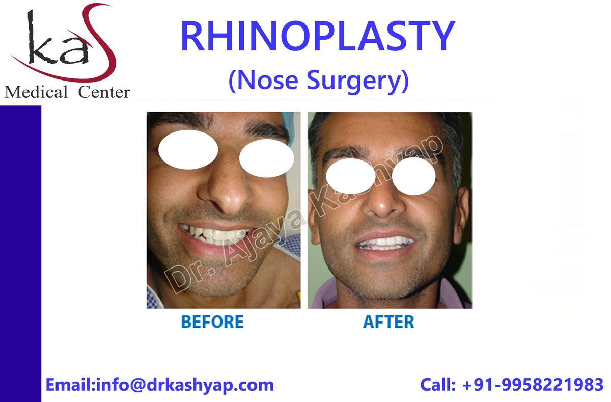 AjayaKashyap's tweet photo. Specialist #Nose Surgeon in South Delhi, India. Book you appointment for #Rhinoplasty surgery consultation call @ +91-9958221983
For Email: info@drkashyap.com
#NoseSurgery #TipNose #NoseReshape #NoseJob #NoseCorrection #EthinicRhinoplasty #NoseJob #AugmentationRhinoplasty https://t.co/D4qPiSMe0k