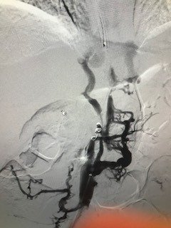 MontefioreRAD's tweet photo. Leg AV graft & severe pain in setting of chronic IVC occlusion #irad + #rfwire + #fluency=#paingone #wecanrecan #withoutascalpel #miips @joeygolow https://t.co/d6qxzIBBEp