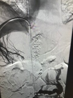 MontefioreRAD's tweet photo. Leg AV graft & severe pain in setting of chronic IVC occlusion #irad + #rfwire + #fluency=#paingone #wecanrecan #withoutascalpel #miips @joeygolow https://t.co/d6qxzIBBEp