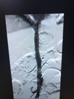 MontefioreRAD's tweet photo. Leg AV graft & severe pain in setting of chronic IVC occlusion #irad + #rfwire + #fluency=#paingone #wecanrecan #withoutascalpel #miips @joeygolow https://t.co/d6qxzIBBEp