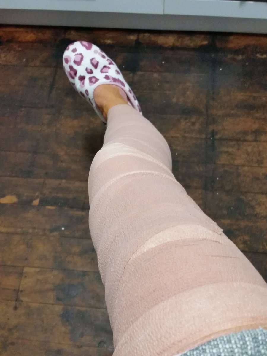 My sexy leg after  operation  varicose veins