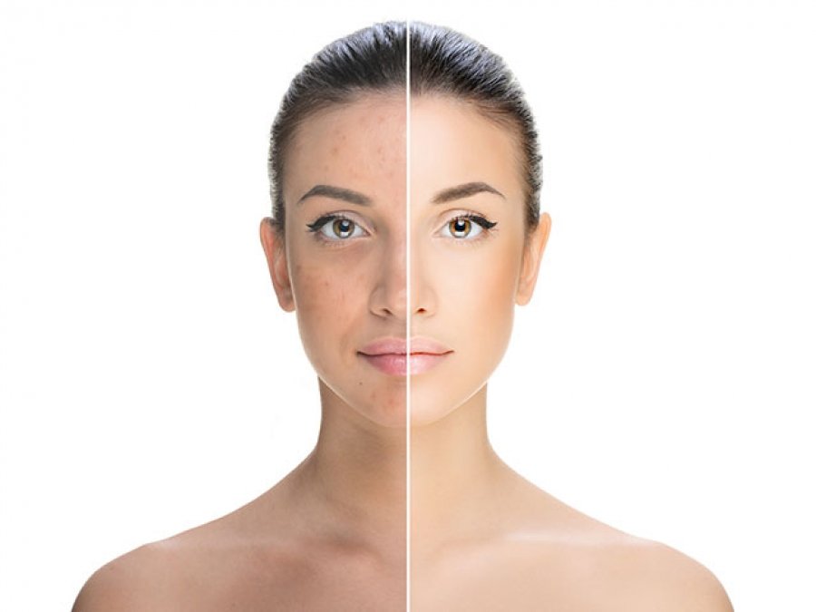 ¿Por qué es importante realizarnos un peeling químico?

BENEFICIOS:

- Tono de piel más uniforme
- Disminución o eliminación de manchas y cicatrices.
- Minimiza poros
- Piel limpia de impurezas
- Ayuda a mejorar los cuadros acnéicos
- Mejora la producción de colágeno y elastina