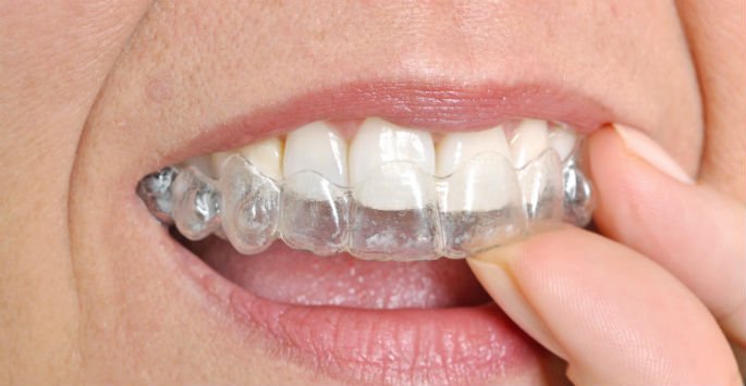 One of the many benefits of #Invisalign is that you can eat &amp; drink what you want bit.ly/2Cg92Ab