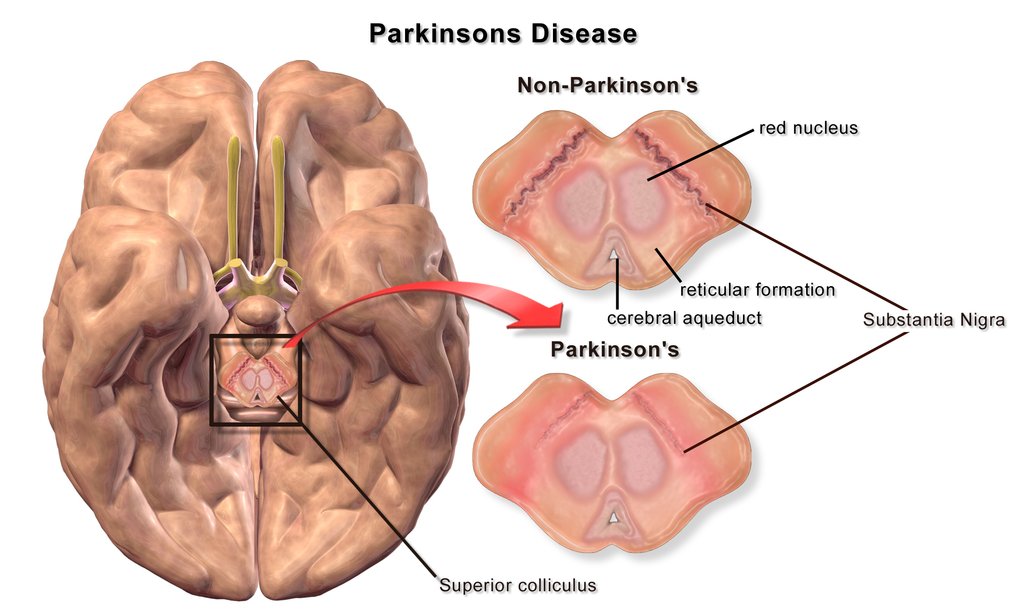 Sneurofeedback's tweet photo. Can Neurofeedback be an Effective Treatment for Parkinson’s Disease?
Read more: https://t.co/4UryNDJHUn https://t.co/lC6Ihkhvgn