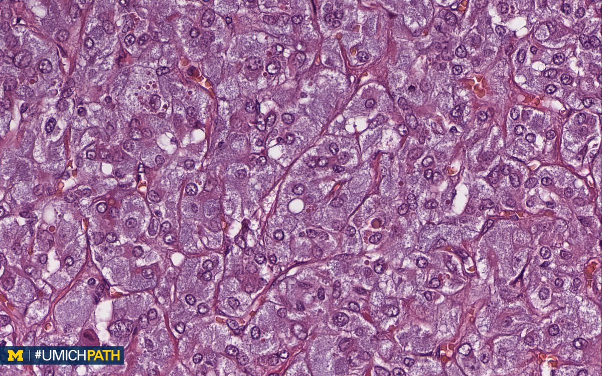 UMichPath's tweet photo. 🔬Adrenal gland #Pathology, day 3

➡️What’s your #DailyDx of this adrenal mass?

➡️What syndrome(s) is/are associated with this diagnosis?

➡️We’ll tweet the answers and some quick facts tomorrow!
#UMichPath #EndoPath https://t.co/1lmbWVZCAb