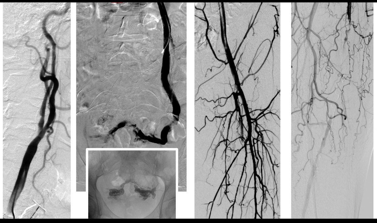 AAlonsoBurgos's tweet photo. Intensas las últimas 24h de la Unidad de Cir. Vascular y Rad. Intervencionista en #CUNMadrid: #TCAR #PelvicEmbolization #CriticalLowerLimbIschemia #SFA , @Nacho_Leal_ mañana más!!! 😅😅💪💪 https://t.co/TQmwrqZvzU