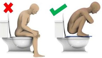 Toilets are bad and unnatural particularly for shitting. The posture when shitting on toilets puts strain on your intestines. This is the truth, no matter how difficult it is to accept.