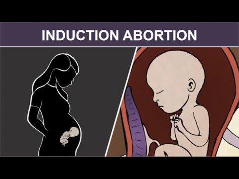 MPPTNews's tweet photo. #repealthe8th - Educational video showing 3rd Trimester Induction Abortion: Injection and Stillbirth https://t.co/2Lh19Rmo5Z https://t.co/OOmuXg1TID