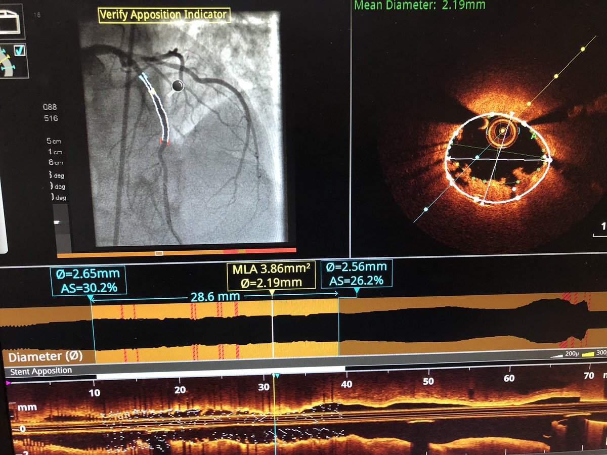 PrecisionPCI's tweet image. @DrChuckSimonton this is the OCT case I was telling you about. Significant thrombus protrusion through DES cells. #PCIOptimization showing &amp;gt;30% residual stenosis not seen on angio. Improving procedural outcomes through awareness 👍
