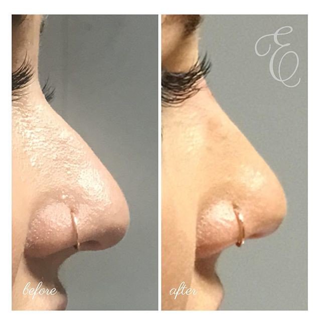 estheticsNE's tweet photo. #Dermalfillers and #Botox can change drastically change the way you look— #nosurgery needed!  #nonsurgicalnosejob #estheticscenterne #La... https://t.co/MvCPY4Ilsa
