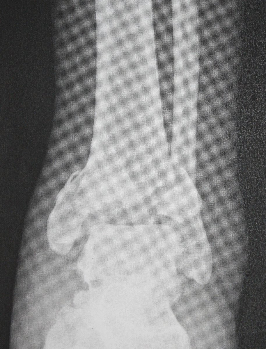 sportsfootankle's tweet photo. #Pilonfractures occur at the lower end of the tibia and involve the weight-bearing surface of the ankle joint. In some cases, the fibula may also be fractured. https://t.co/pYDc8YTLm9 https://t.co/0pv1FeK9Ya