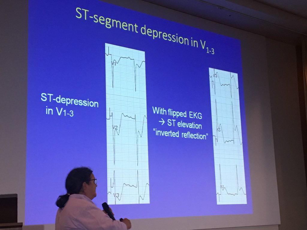 GaryGChimesIn's tweet photo. Dr. Torrey’s Point #2: S-T depression in leads V1-V3 is highly indicative of POSTERIOR MI. The S-T Elevation MI is best seen as S-T elevation by turning EKG up-side down. See the photo. More to follow #litsem2018 #Foam@ltinSkubi https://t.co/JEwsNH2pbD
