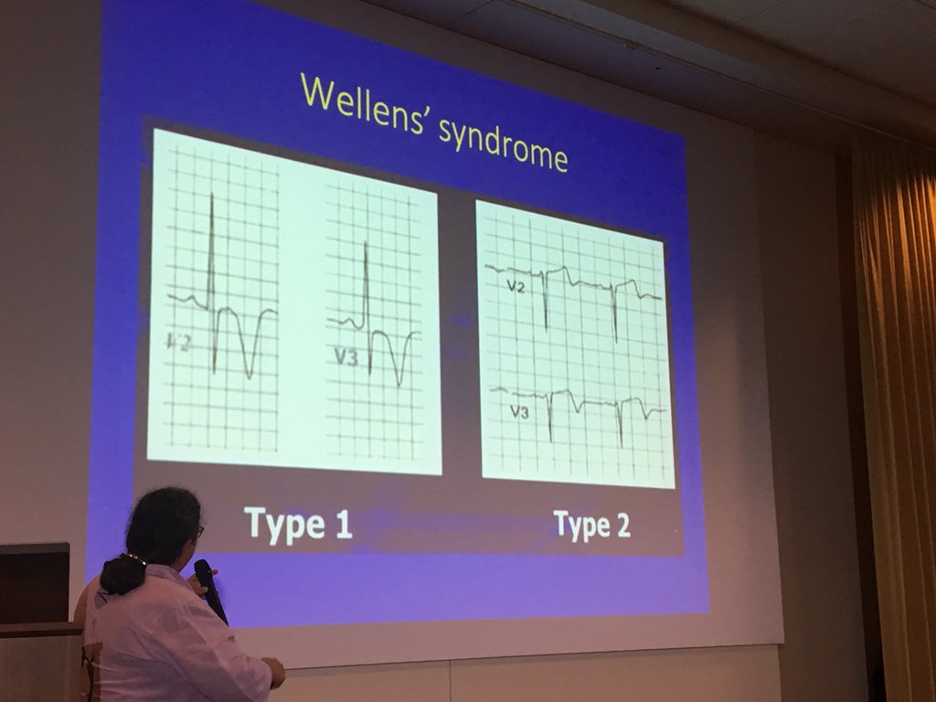 GaryGChimesIn's tweet photo. Dr Torrey’s 3rd point: “Wellens Warning” (of L Anterior Descending disease) consists of DEEPLY INVERTED (Type 1) or BIPHASIC T-Waves in leads V2-V4 (Type 2), which are changed from patient’s prior EKG &amp; seen at rest, even with normal Troponin levels #litsem2018 #Foam@ltinSkubi https://t.co/sYt8A17CJ0