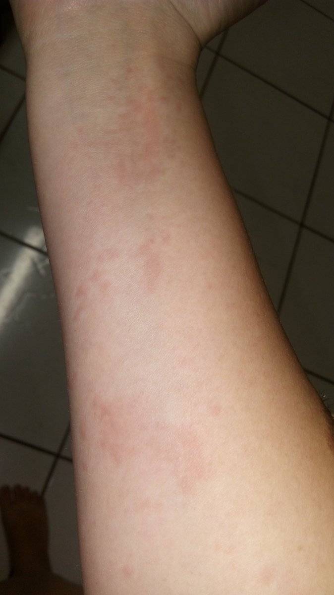 IsadoraVilla's tweet photo. @bemestar dormi em um colchão velho, madrugada acordei com coceira ate na cabeça e minha pele amanheceu toda manchada.Pode ser alergia a ácaros.? #vcnobemestar https://t.co/N56Zg7qYw1