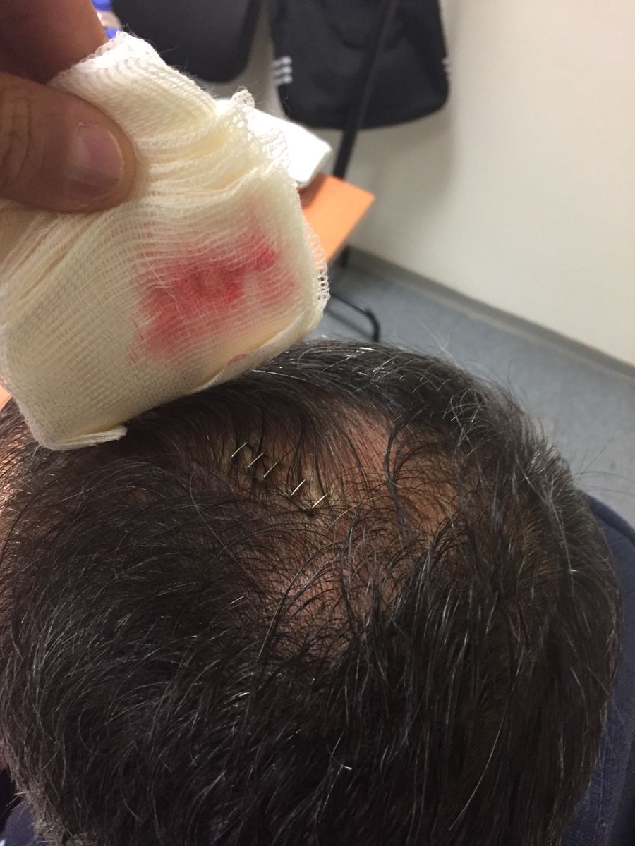 <a href="/12numaraorg/">12 Numara 🇹🇷</a> Bu twittimi kaydedin!!! 6 yillik doktorum binden fazla stapler dikisi attim kafaya, ne boyle bir yarik(!) gordum nede hayatimda bu renkte bi kan.. Yarin bisturi ile cizecekler kafayi iste yarik bu diyecekler!!!!