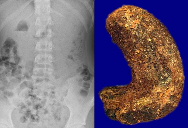 Teenager with abdominal obstruction. #pathology #pediatricpathology #SLUpathology #pedipath