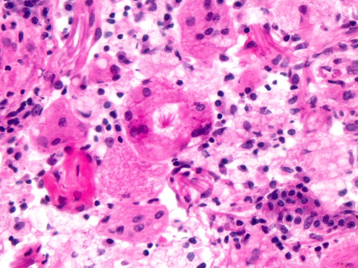Sanjay Mukhopadhyay (@smlungpathguy) on Twitter photo O brave and wise Tweeples, frozen section of a lung nodule. What is your diagnosis?
#Pulmpath
<a href="/pembeoltulu/">Pembe Oltulu, MD</a> <a href="/Haneen_Maghrabi/">Haneen Al.Maghrabi</a> <a href="/Missle/">Missle</a> <a href="/VijayPatho/">Vijay Shankar S</a> <a href="/kriyer68/">Kalyani Bambal</a> @PallaviPatilMD <a href="/BinXu16/">Bin Xu</a> O brave and wise Tweeples, frozen section of a lung nodule. What is your diagnosis?
#Pulmpath
<a href="/pembeoltulu/">Pembe Oltulu, MD</a> <a href="/Haneen_Maghrabi/">Haneen Al.Maghrabi</a> <a href="/Missle/">Missle</a> <a href="/VijayPatho/">Vijay Shankar S</a> <a href="/kriyer68/">Kalyani Bambal</a> @PallaviPatilMD <a href="/BinXu16/">Bin Xu</a>