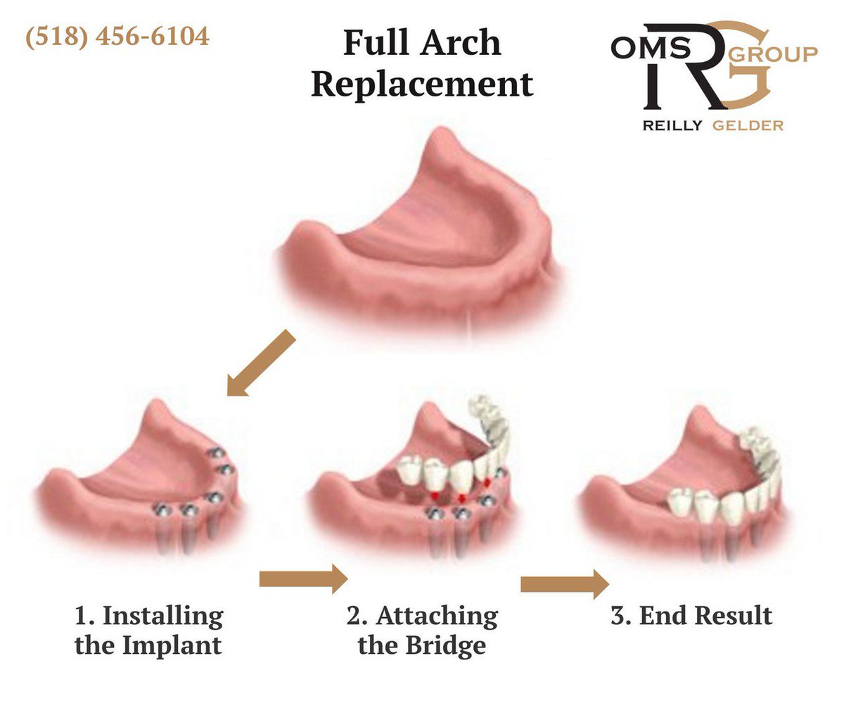 ReillyGelderOMS's tweet image. When all teeth are missing, a #FixedBridge anchored to #DentalImplants is often the best solution. Here’s a quick look at full arch replacement options. #FullArchReplacement #MissingTeeth #ReillyGelderOMS: ow.ly/A4VA30jq8TW