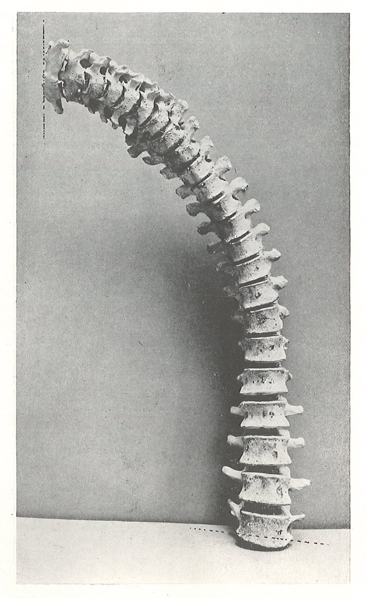 脊柱の回旋と側屈を示す標本写真。脊柱の回旋も側屈も、腰から上で合算すると90度を越える。100度と言い切っているものもあるが、計測が5度刻みだったりするので、あくまで目安でしょう。フィック『関節の解剖学』(1911)より。 
