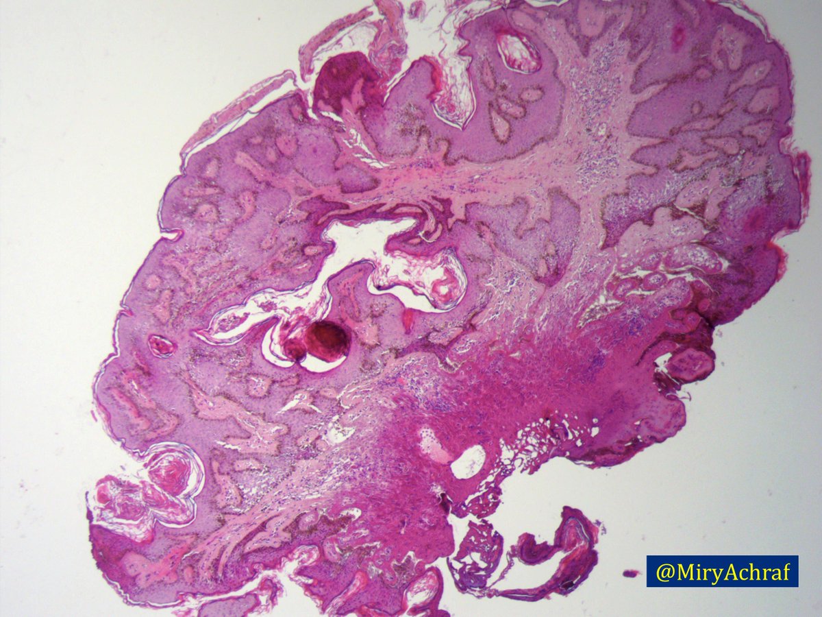 Fibroepithelial papilloma causes, Recent Posts Fibroepithelial papilloma