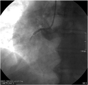 CRMjournal's tweet photo. #Pingpong technique for #treating a #balloon #uncrossable #ChronicTotalOcclusion (#CTO) by Michael Koutouzis et al. in Jan/Feb issue: https://t.co/1hIFymxV9d https://t.co/3KtP9ubAqz