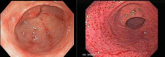 BQDSD_02E7's tweet photo. Las pruebas esenciales para determinar la gastritis constituyen los hallazgos histológicos como metaplasia intestinal e infiltrado inflamatorio; y los hallazgos de la gastroscopia como eritemas, edemas, petequias e inflamación de los vasos sanguíneos y nodularidad. @UNAM_CUD https://t.co/QJbPIRsSqS
