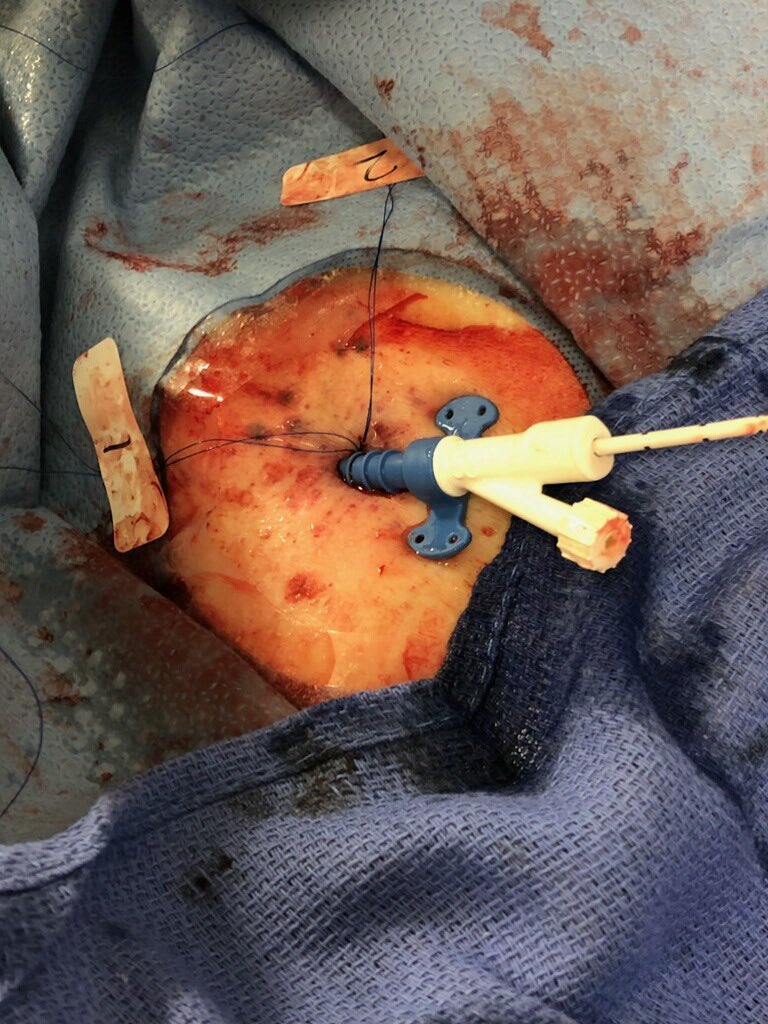 agtruesdell's tweet image. 2/3: #PercAx access...