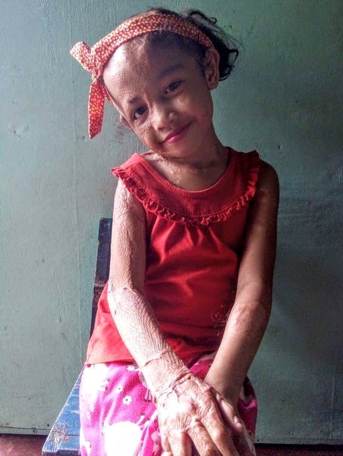 GoGetFunding's tweet image. Johnny's daughter suffered terrible injuries in a house fire and now she needs your help: gogetfunding.com/reconstruction… #HelpJohnny #MedicalBills #GoGetFunding