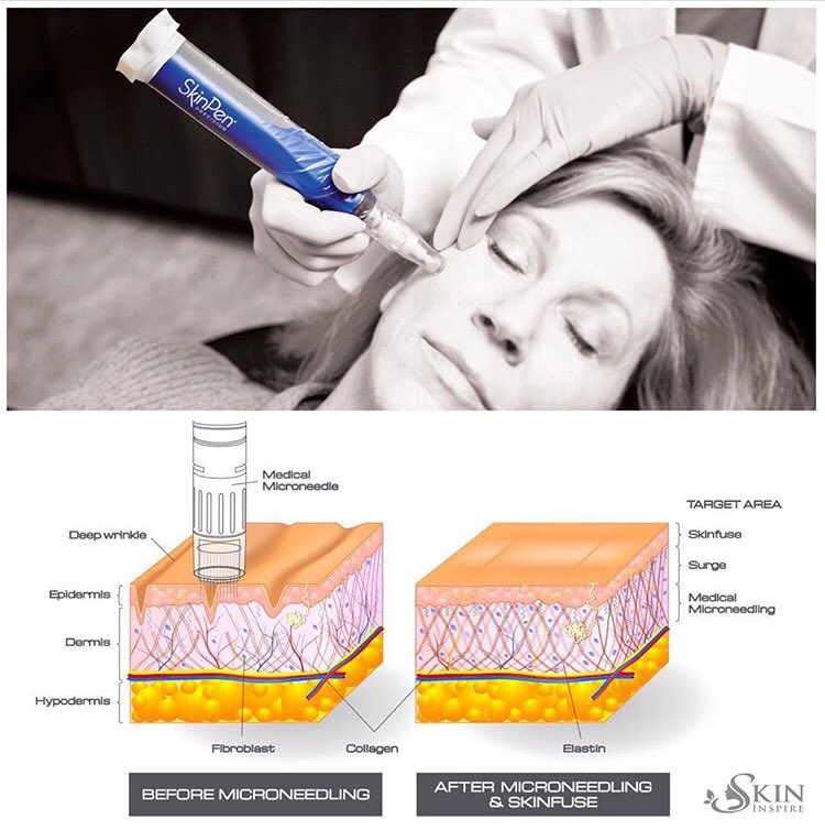 SkinPenUK's tweet photo. Benefits of #microneedling #skinpen!

Combat lines and #wrinkles by asking your #aesthetician #dermatologist or #aesthetics doctor for a #skinpenprecision treatment!  #microneedling for #antiageing #acnescarring #pigmentation and more! https://t.co/9JWBFsrAGY