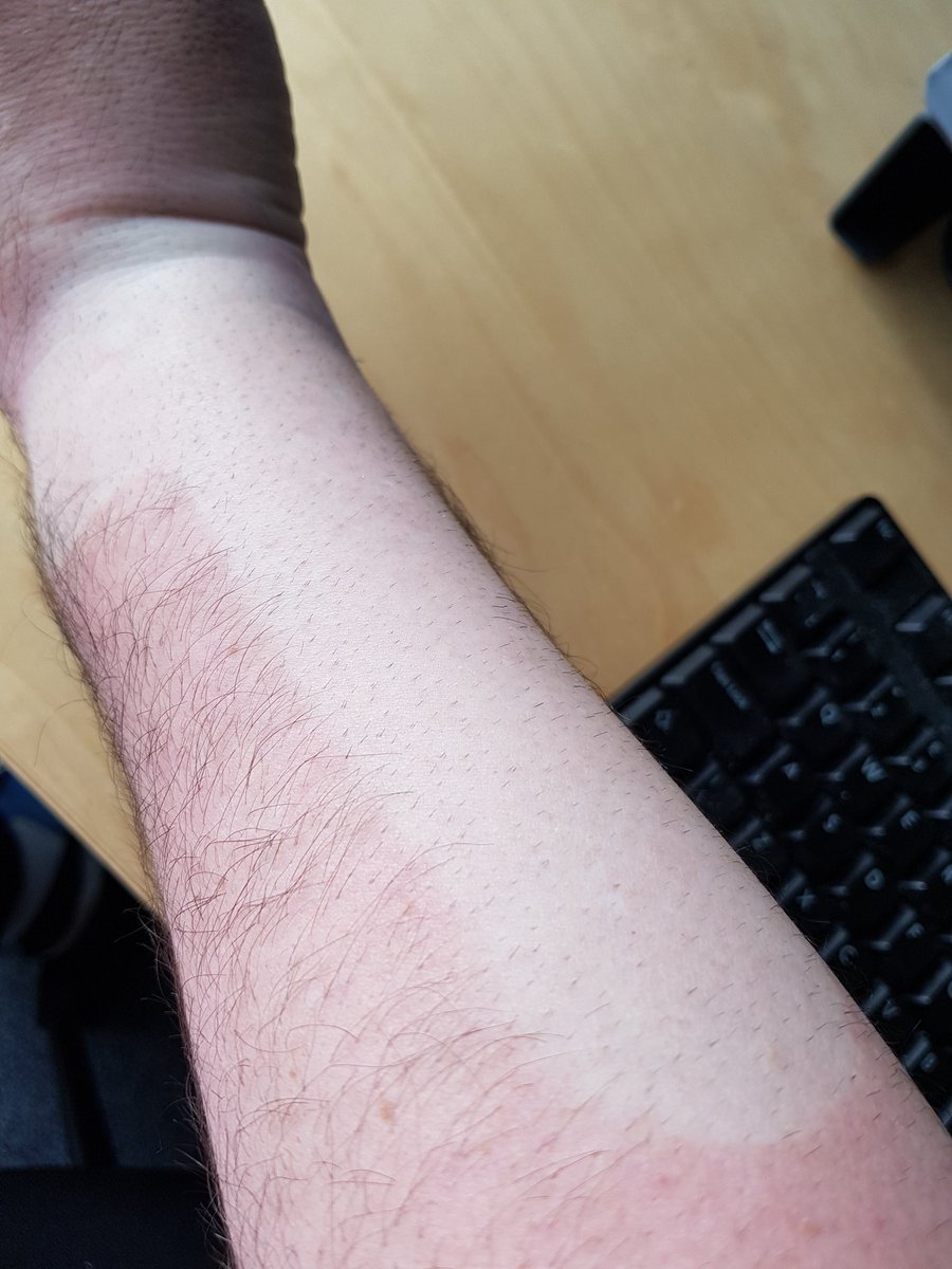 crashtest_dobby's tweet photo. @PeterFinchGolf literally feel your pain with the wrist injury. I'm still wearing the sports tape and came out with this cracking tan line yesterday. No idea how I'll even up the tan now this year.
#stunner
#tanningproblems https://t.co/D5IAMPuDLM