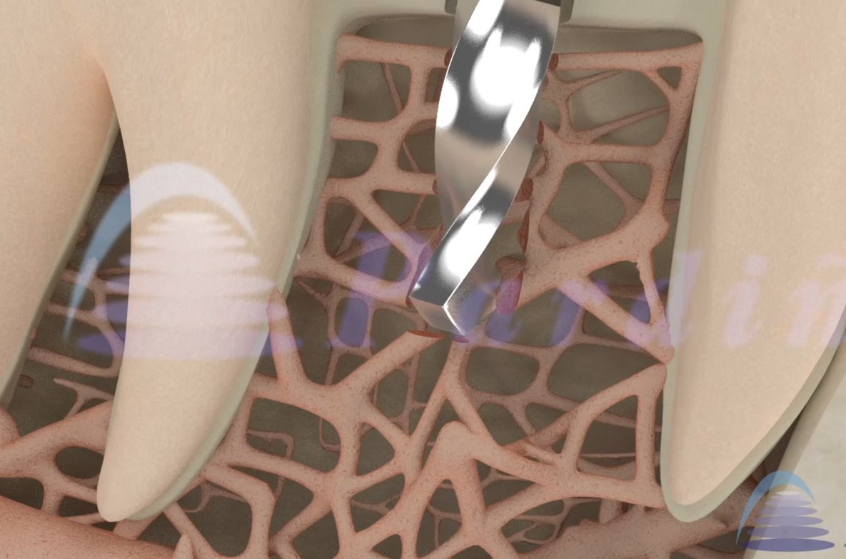 ClinicaPardinas's tweet photo. Así funciona la #osteointegración, el proceso por el cual se crear una conexión directa y funcional entre los #implantes y el hueso dental https://t.co/cw72OkBmRg https://t.co/Pnyu8NlmJa