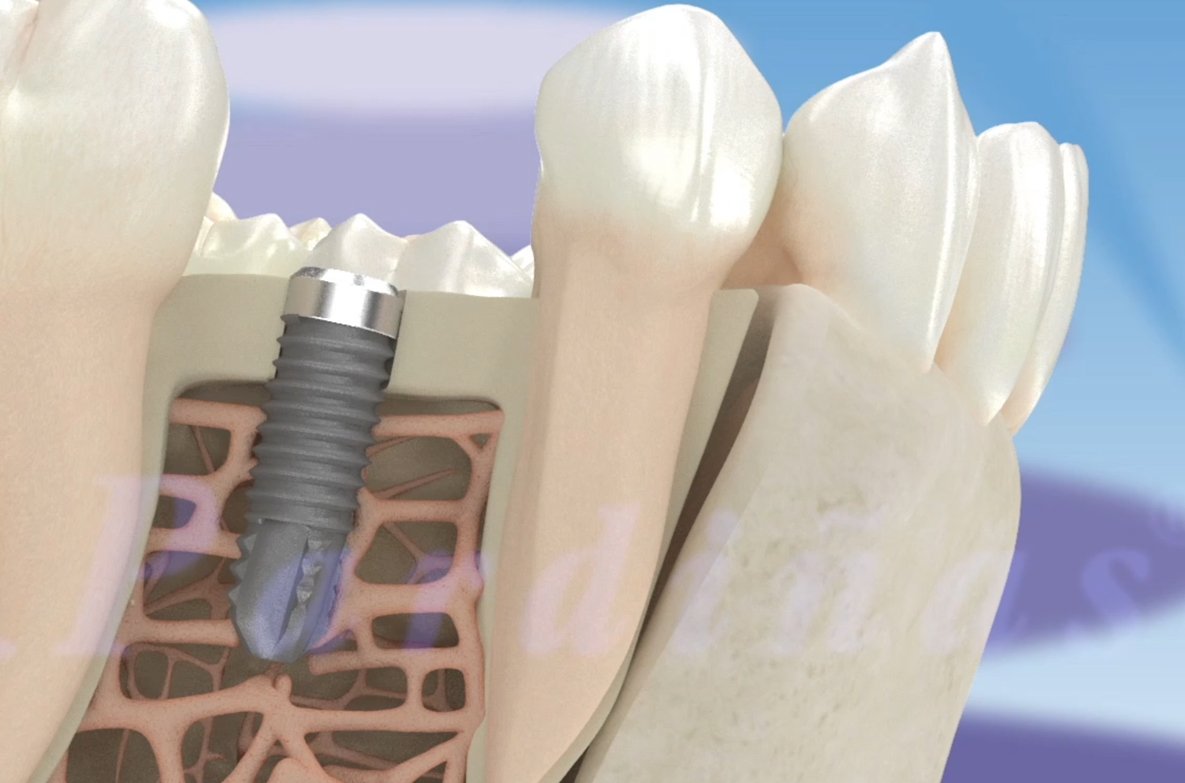 ClinicaPardinas's tweet photo. Así funciona la #osteointegración, el proceso por el cual se crear una conexión directa y funcional entre los #implantes y el hueso dental https://t.co/cw72OkBmRg https://t.co/Pnyu8NlmJa