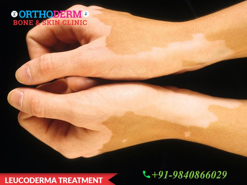 joannfmasten's tweet image. RT  Leucoderma Treatment - Orthoderm Bone &amp;amp; Skin Clinic Book Appointment: +91-9500165325 Visit More@ orthoderm.in/dermatology.php #Leucoderma #Leucodermatreatment #antiagingtr…