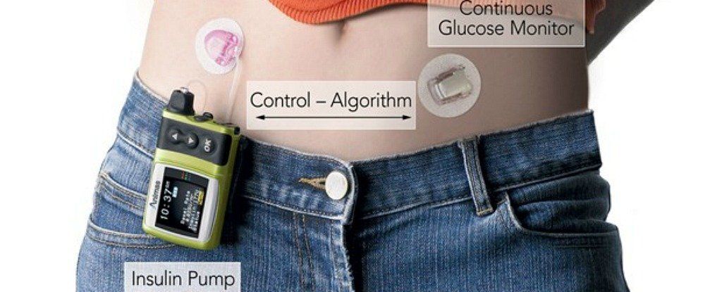 Supplythis's tweet photo. Revolutionary 'Artificial Pancreas' Is Proving to Be Incredible For Type 1 Diabetics https://t.co/EKDmBRCwMF https://t.co/yrMJwEFt37
