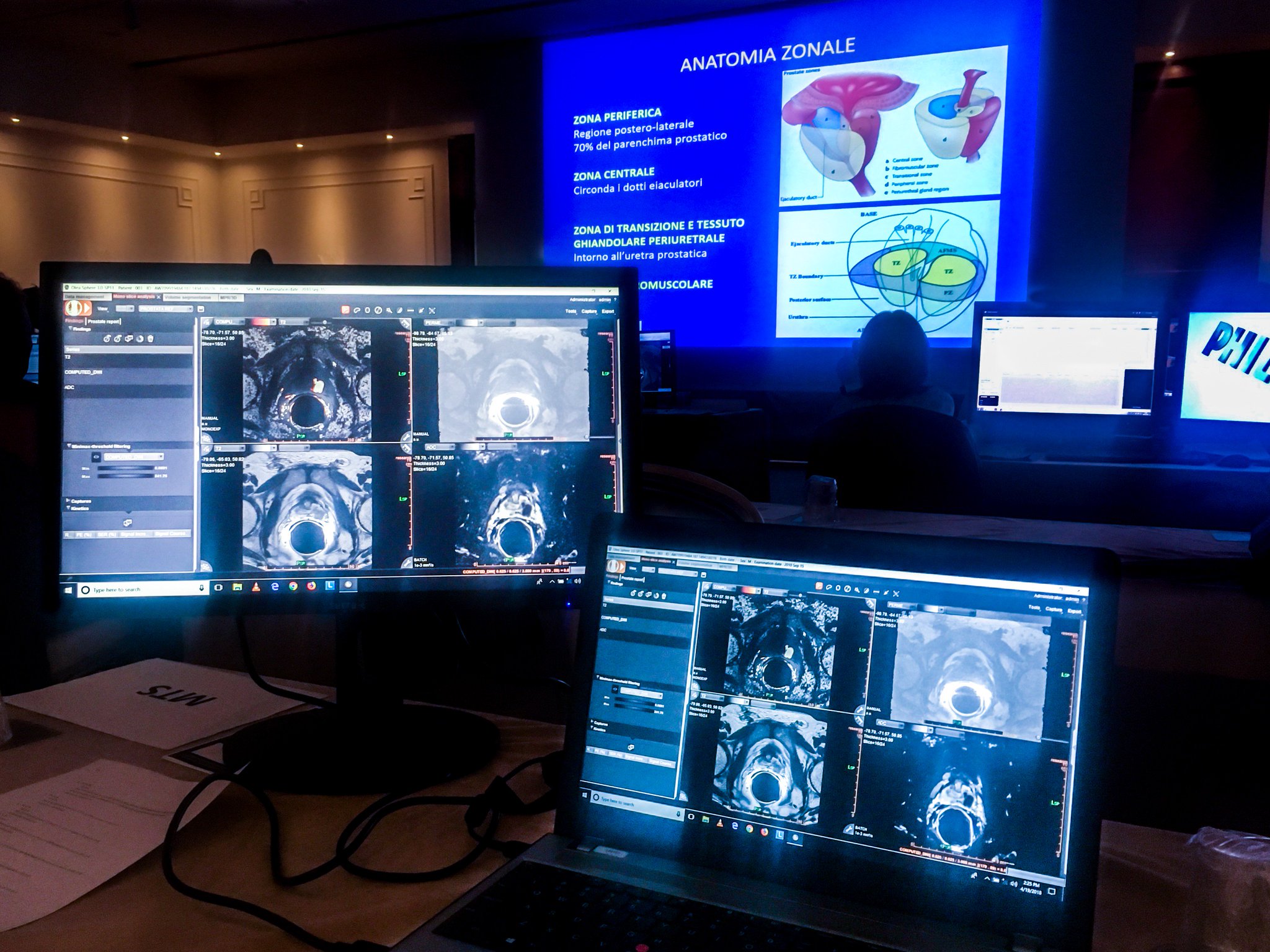 zona periferica prostata mri zona periferica prostata mri