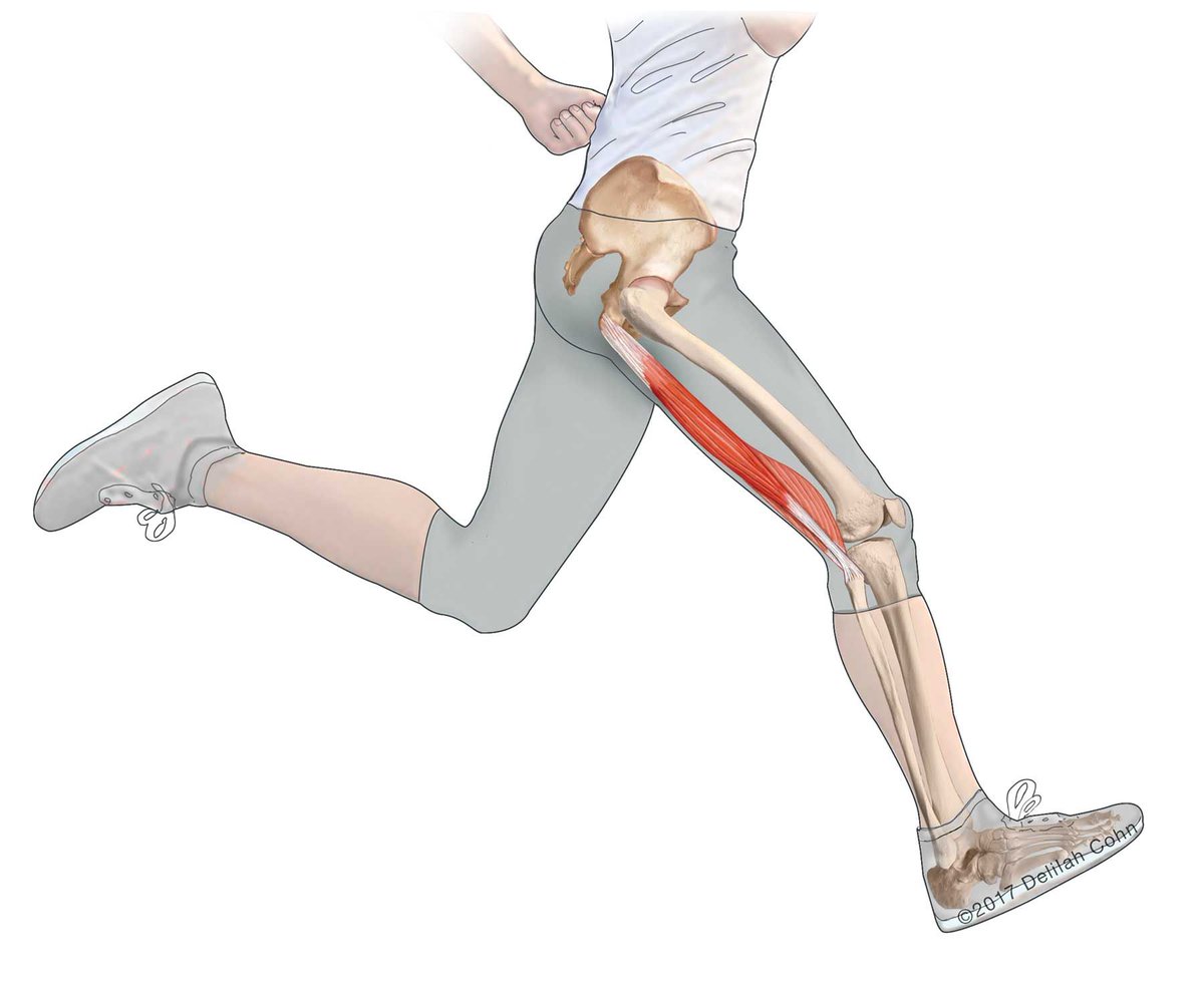nashvilleorthos's tweet photo. Acute rupture of the #hamstringtendon from the ischium can occur and is usually caused by a fairly violent force. Most commonly, the #knee is extended and the trunk is forced forward, causing the #hip to flex. https://t.co/1GWSur55jD https://t.co/QQMzeRHKUZ