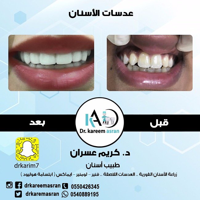 من أهداف #عدسات_الاسنان إنشاء بنية واقية
لـ #حماية_الاسنان الضعيفة والتالفة

#تسوس_اسنان
#تنظيف_اسنان
#تجميل_اسنان