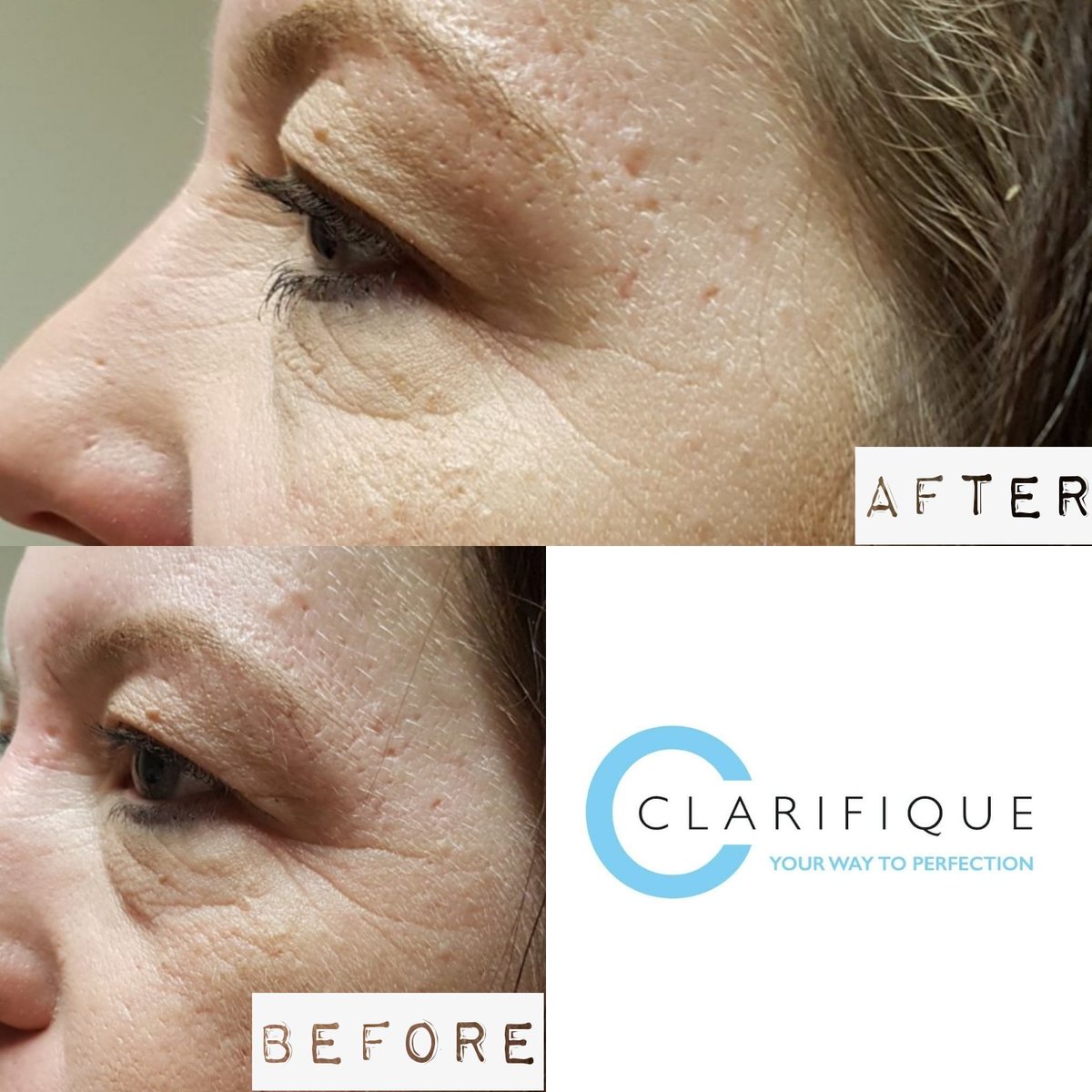 Clarifique1's tweet photo. Two areas of anti-wrinkle injections, this lady was worried about her crows feet and wanted a fresher look. ❤ Look achieved, ready for the sun 🍹🌞 #bocouture #antiwrinkleinjections https://t.co/fKvoXndOhu
