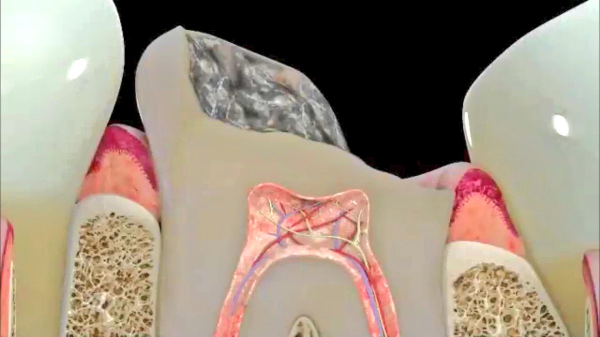 malshehri_dr's tweet photo. #Deep_Margin_Elevation
#The_Cervical_Margin_Relocation
#CMR https://t.co/boT3srjJWL