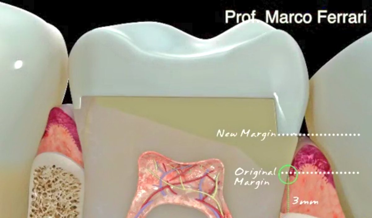 malshehri_dr's tweet photo. #Deep_Margin_Elevation
#The_Cervical_Margin_Relocation
#CMR https://t.co/boT3srjJWL