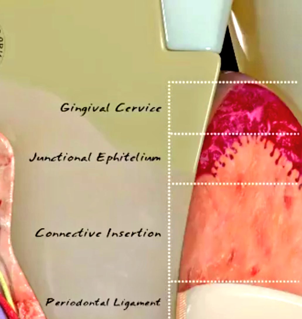 malshehri_dr's tweet photo. #Deep_Margin_Elevation
#The_Cervical_Margin_Relocation
#CMR https://t.co/boT3srjJWL