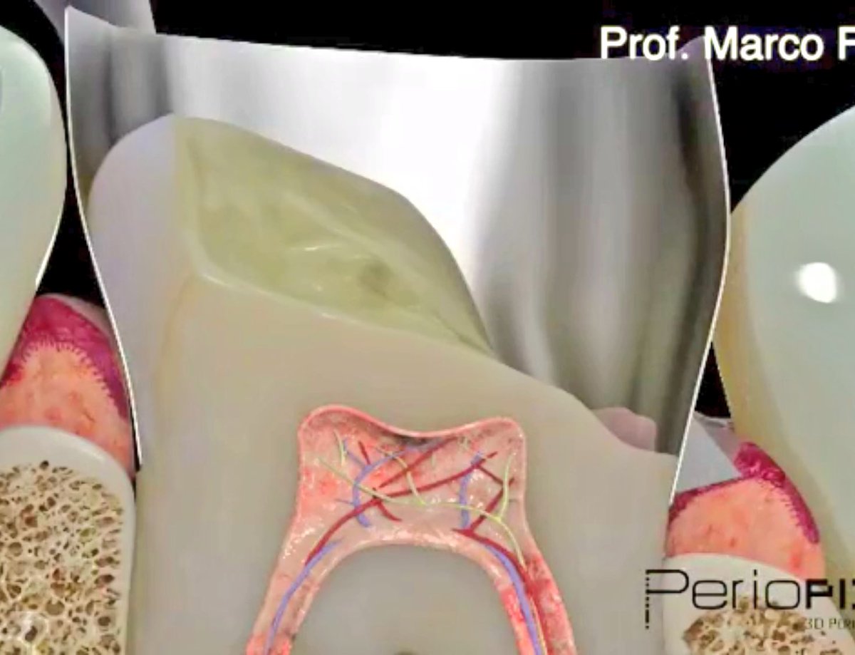 malshehri_dr's tweet photo. #Deep_Margin_Elevation
#The_Cervical_Margin_Relocation
#CMR https://t.co/boT3srjJWL