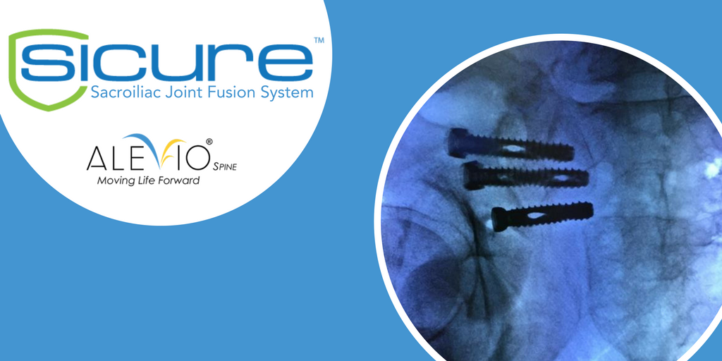 AlevioSicure's tweet photo. The #SiCure is a comprehensive #sacroiliacjoint fusion system with uniquely designed titanium screws. #sijoint #jointfusion #bonescrews https://t.co/KjfdZsLRWc
