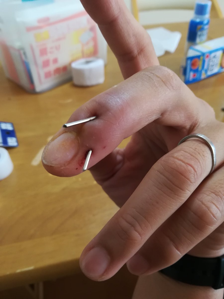 ネオン 弓兵 どりちん V Twitter 実は今 左中指の骨性マレット 要は突き指骨折 治療中につき 指 に太いワイヤーが骨までぶっ挿さしてあるんだけど 消毒のために初めて包帯解いたら結構グロかったよ ネオン 弓兵 どりちん V Twitter 実は今 左中指の骨性マレット 要は突き指骨折 治療中につき 指 に太いワイヤーが骨までぶっ挿さしてあるんだけど 消毒のために初めて包帯解いたら結構グロかったよ